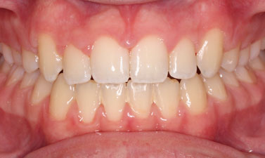 Before & Afters
