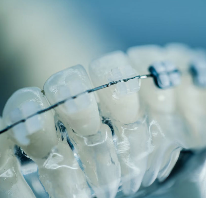 LightForce 3D Braces Smarter Customised Straightening