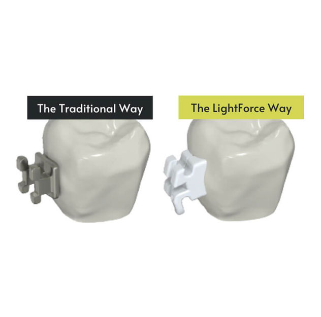 LightForce 3D Braces Smarter Customised Straightening
