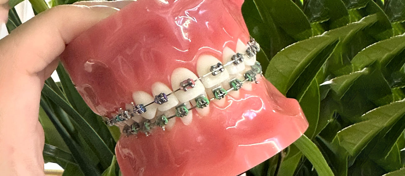 Metal Braces Explained: What They Are and How They Work