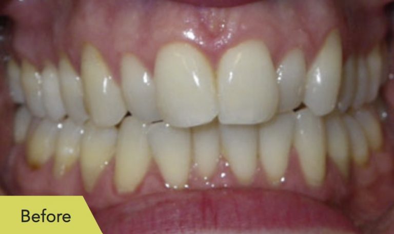 teeth-before-IPR.jpg