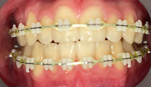 12 months into treatment
