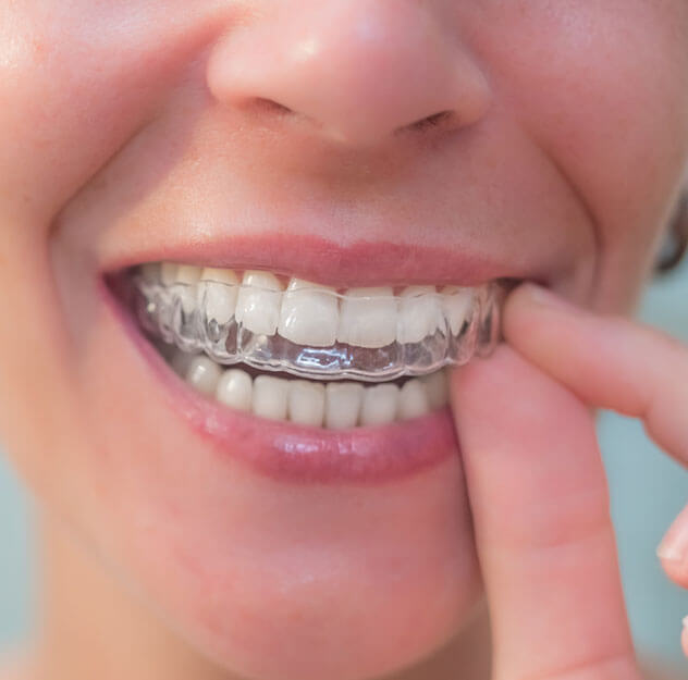 What are Spark Aligners What are Spark Aligners