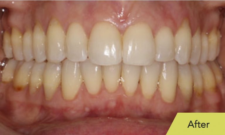teeth-after-IPR.jpg