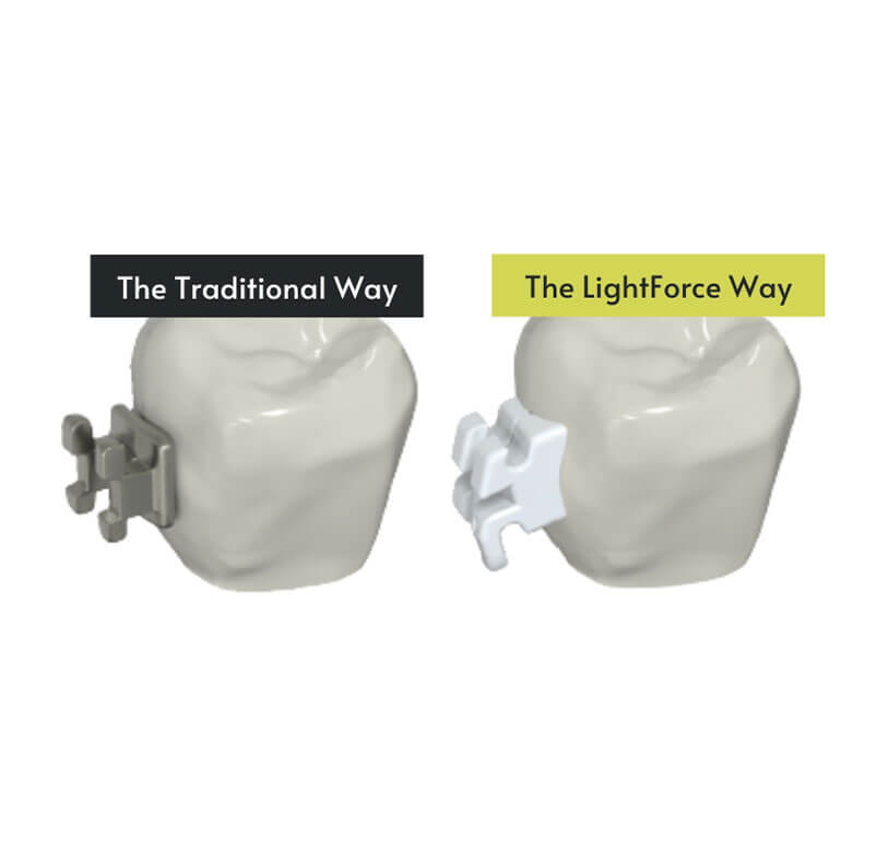 LightForce 3D Braces Smarter Customised Straightening LightForce 3D Braces Smarter Customised Straightening