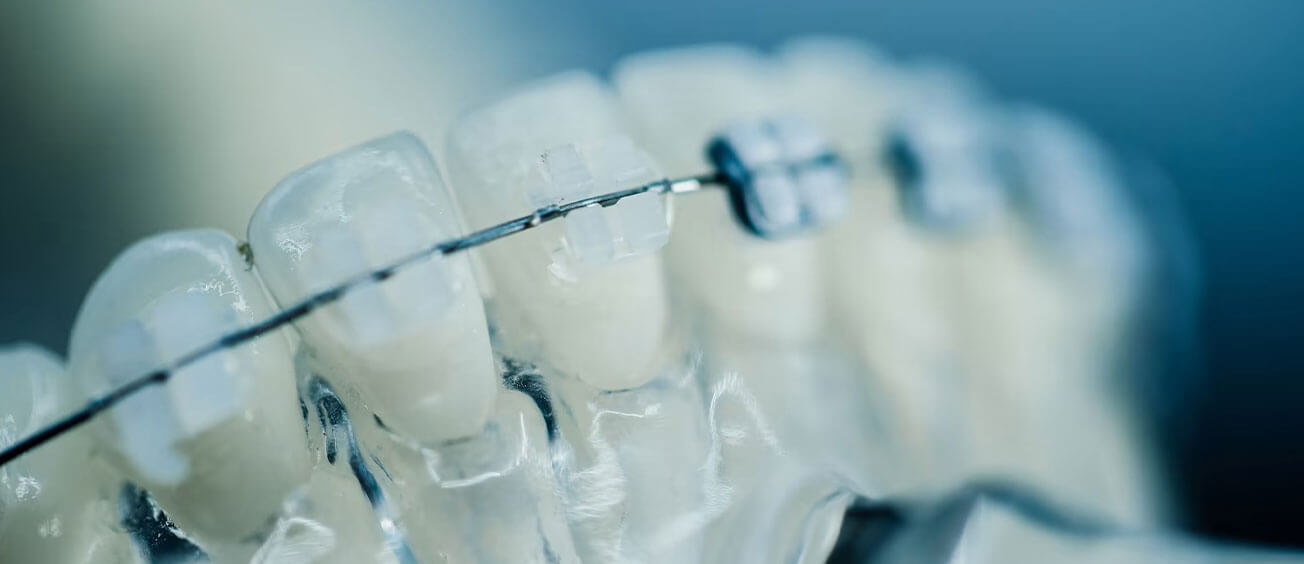L&L Orthodontics: Leading the Way with 3D-Printed Braces in Melbourne