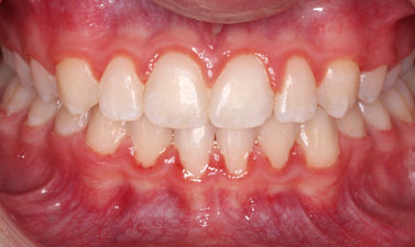 Before & Afters
