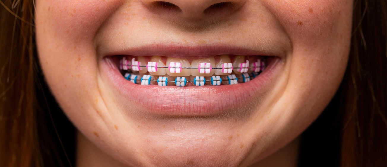 The Essential LightForce™ 3D Braces Care Guide
