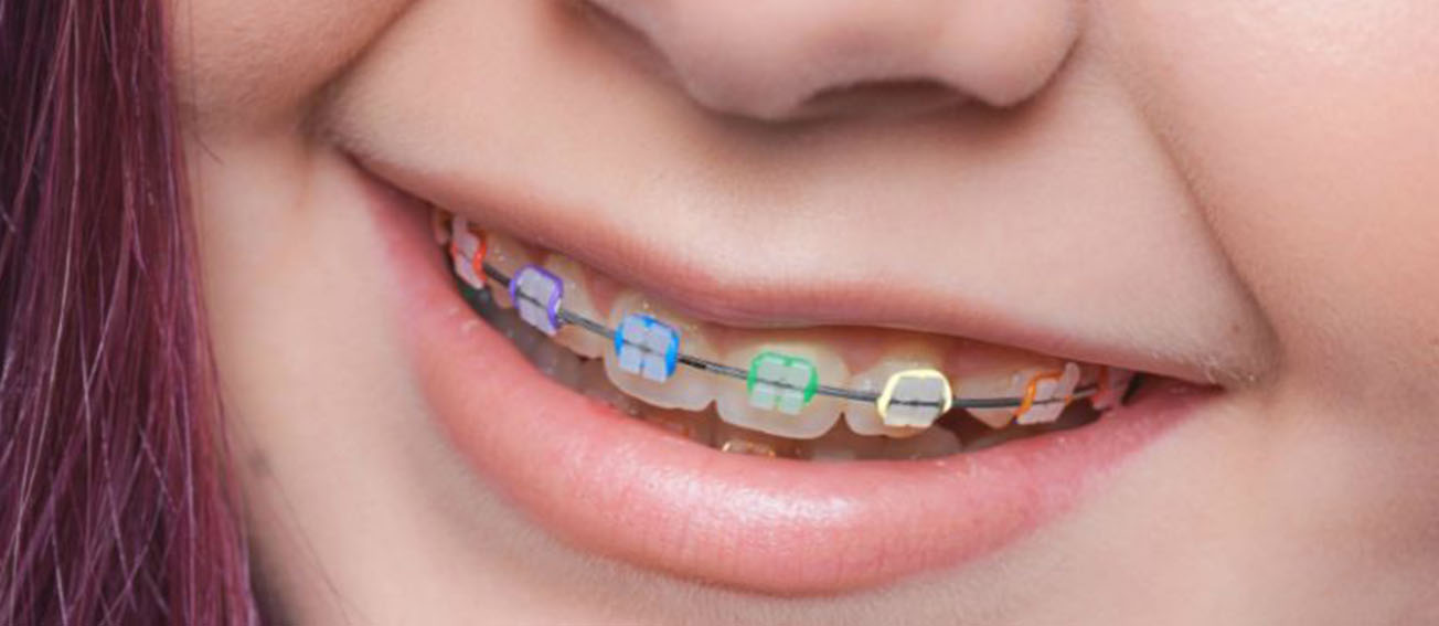 7 Essential Tips for Looking After Your Braces
