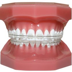 Ceramic braces