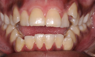 Orthodontic treatment before and after