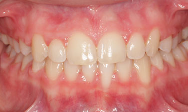 Orthodontic treatment before and after