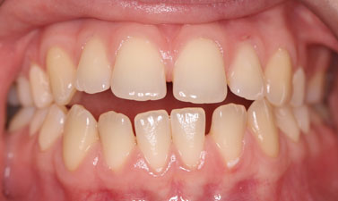 Orthodontic treatment before and after