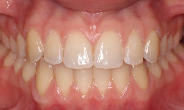 Orthodontic treatment before and after