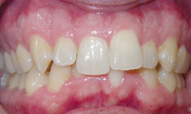 Orthodontic treatment before and after