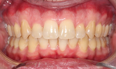 Orthodontic treatment before and after