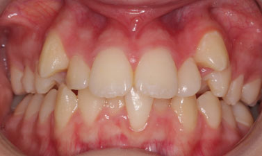 Orthodontic treatment before and after