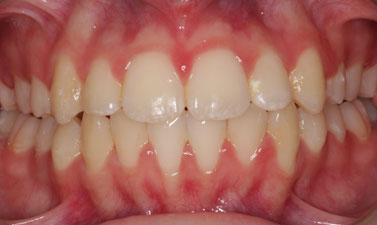 Orthodontic treatment before and after