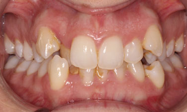 Orthodontic treatment before and after