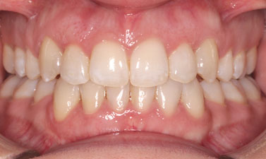 Orthodontic treatment before and after