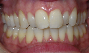 Orthodontic treatment before and after