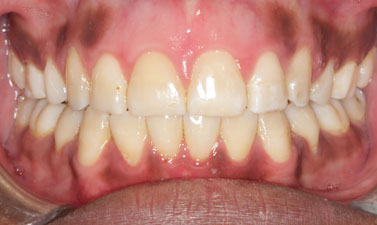 Orthodontic treatment before and after