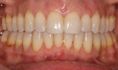 Orthodontic treatment before and after