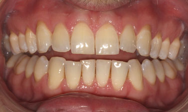 Orthodontic treatment before and after