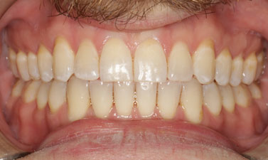 Orthodontic treatment before and after