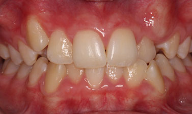 Orthodontic treatment before and after