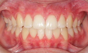 Orthodontic treatment before and after