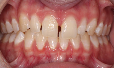 Orthodontic treatment before and after