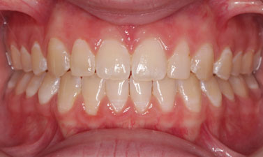 Orthodontic treatment before and after