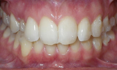 Orthodontic treatment before and after