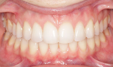 Orthodontic treatment before and after