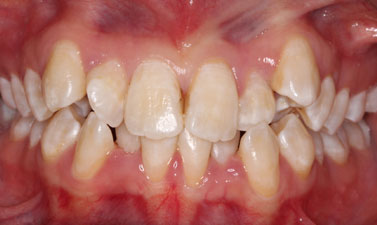 Orthodontic treatment before and after