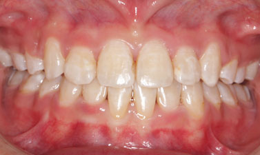 Orthodontic treatment before and after