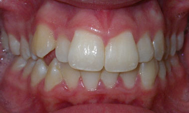 Orthodontic treatment before and after