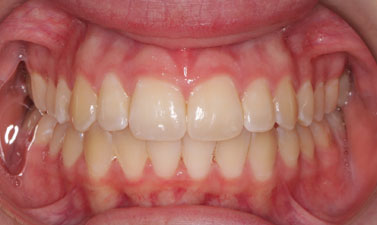 Orthodontic treatment before and after