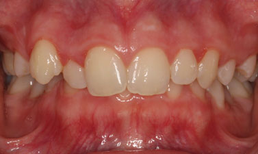 Orthodontic treatment before and after